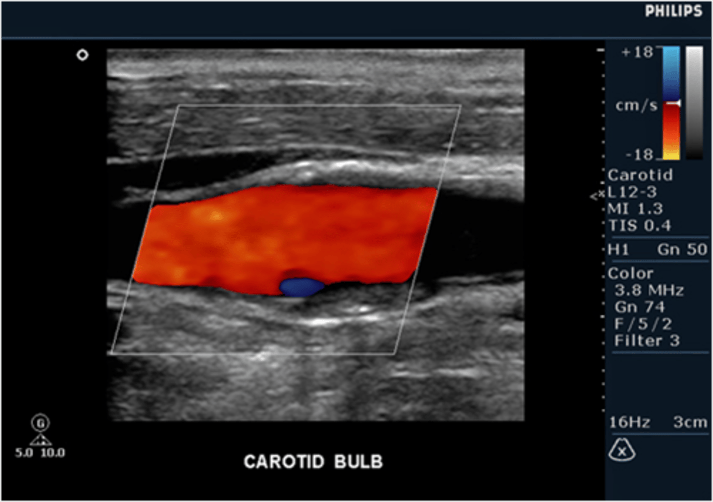 <p>normal, this is a result of boundary layer separation due to change in flow direction at the bulb</p>