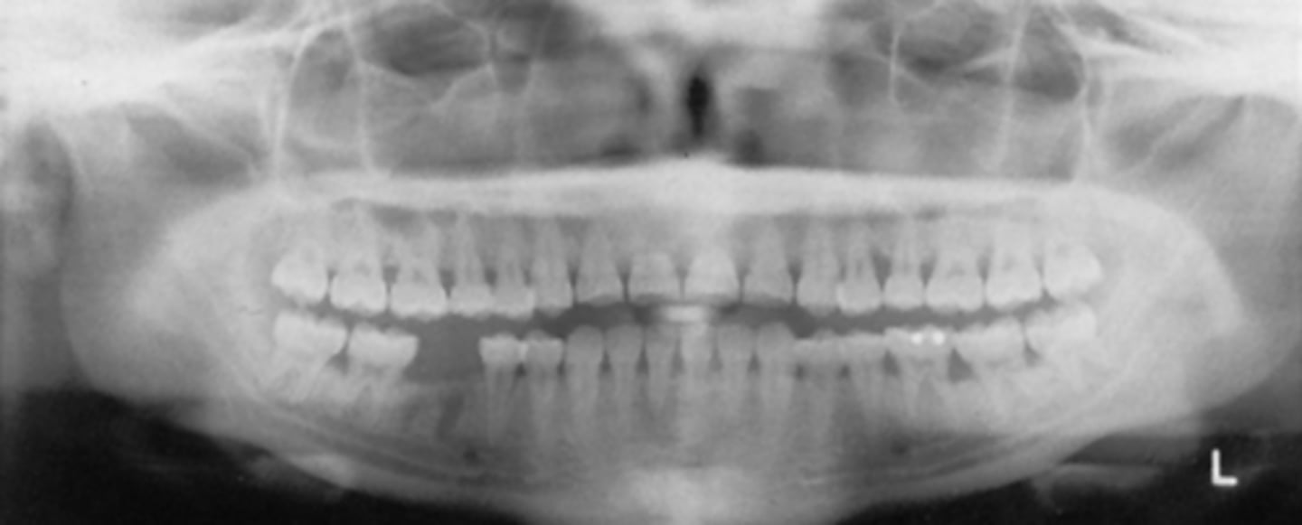<p>What light needs to be repositioned in order to fix the flatness seen in this image?</p><p>A) mid-sagittal</p><p>B) Frankfort plane</p><p>C) focal trough</p>