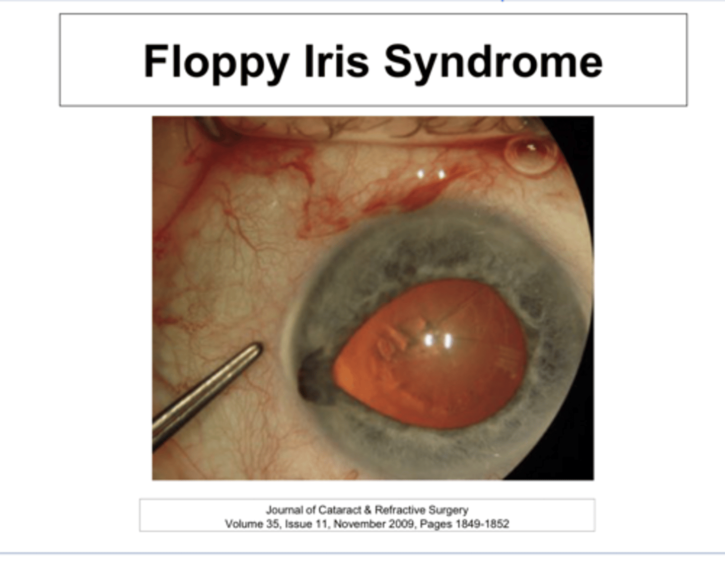 <p>How does Flomax lead to Floppy Iris Syndrome?</p>