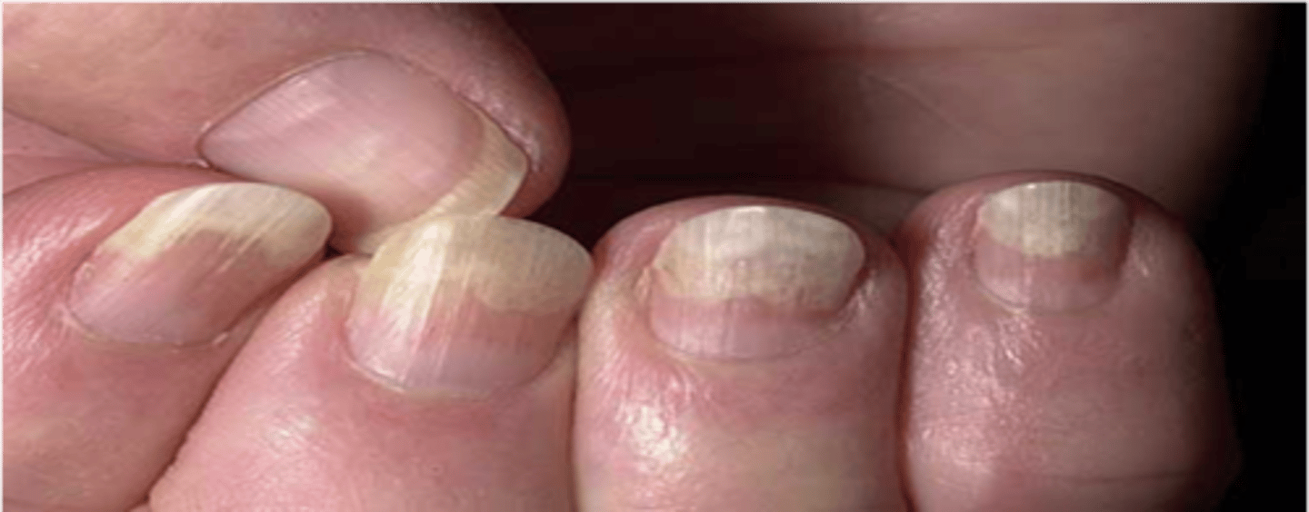 <p>◦Painless separation of the nail plate from the nail bed</p>