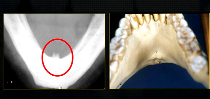 <p>small bony spurs of the genial tubercles </p>