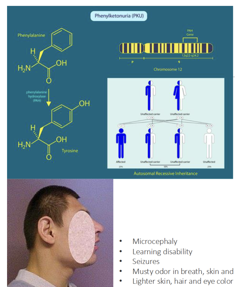 <ul><li><p>Rare autosomal recessive genetic disorder caused by co-inheriting 2 mutatn allels of the PAH gene on chromosome 12</p></li><li><p>PAH gene encodes the phenylalanine hydroxylase enzyme that convert amino acid phenylalanine to tyrosine</p></li><li><p>In phenylketonuria, the loss of PAH enzyme activity results in toxic accmulation of phenylalanine that interfere with newborn development of brain and nervous system</p></li></ul><p></p>