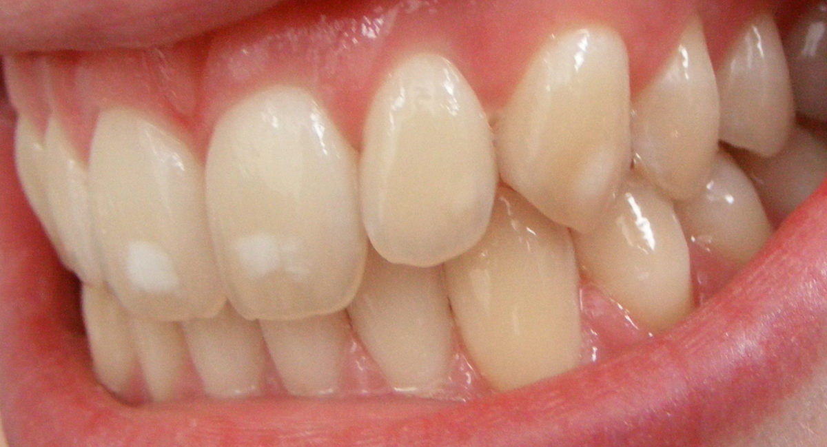 <p>fluorosis</p>
