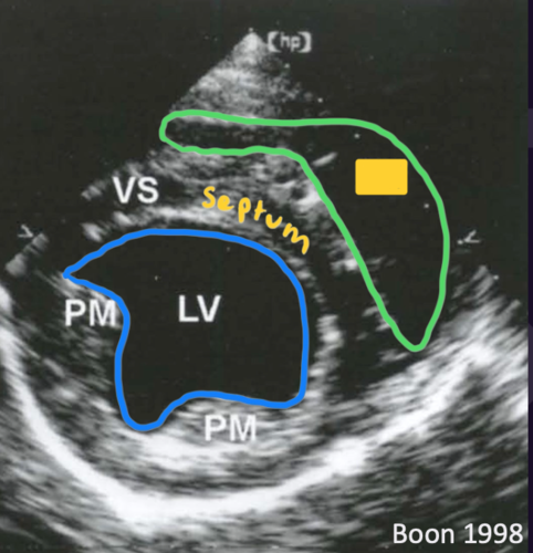 <p>Right parasternal short axis view</p>