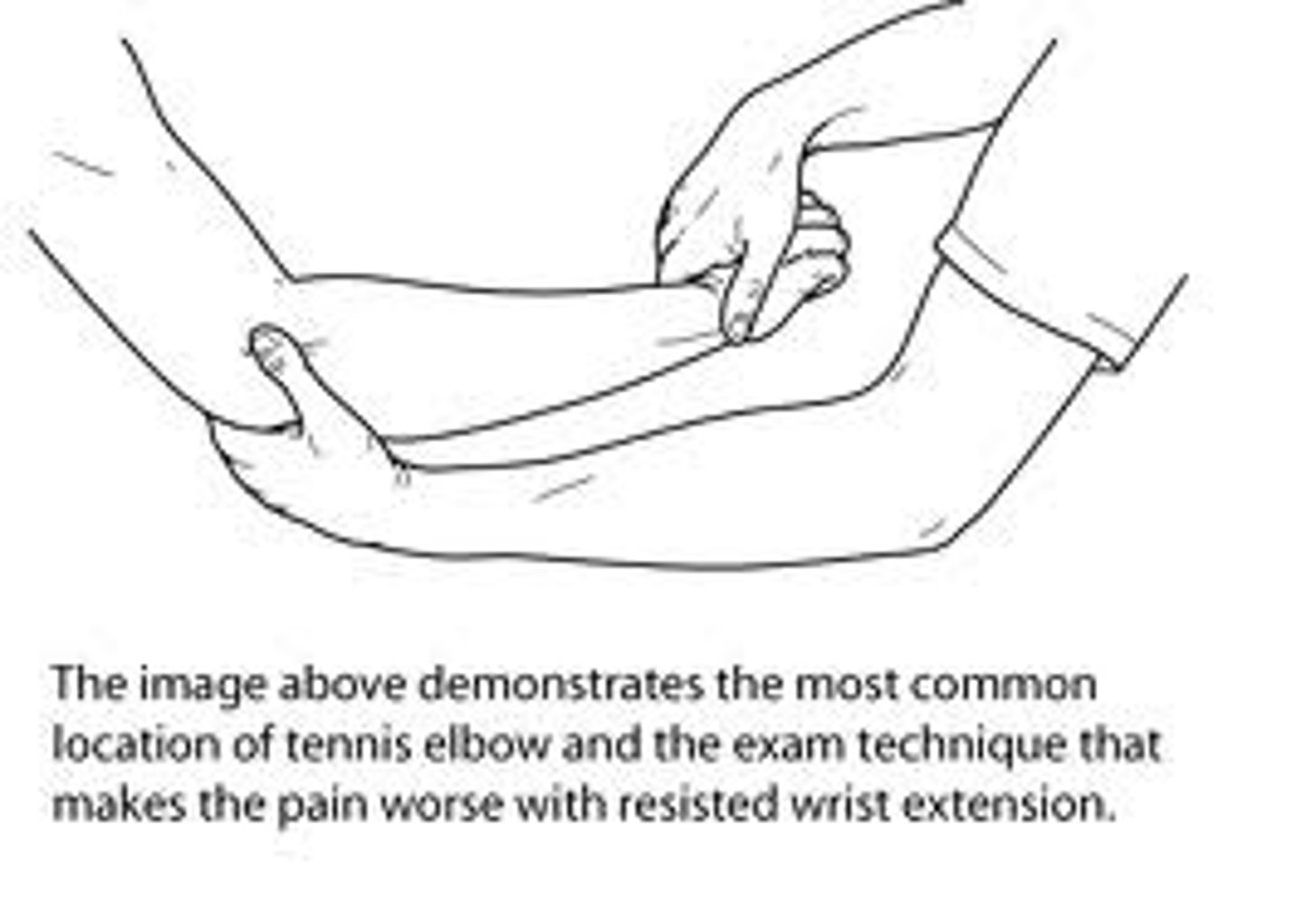 <p>Tennis elbow/ lateral epicondylosis</p>