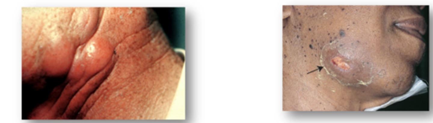 <p><em>Actinomyces israelii</em></p><p></p><p><strong>–Filamentous, Gram-positive rods</strong></p><p></p><p><strong>–Causes cervicofacial actinomycosis</strong></p><p><span style="text-decoration:underline">•Lumpy jaw</span></p><p>•Open draining sinus tracts along angle of jaw and neck</p><p>•Abscesses may form</p><p>•Poor oral hygiene, invasive dental work</p>