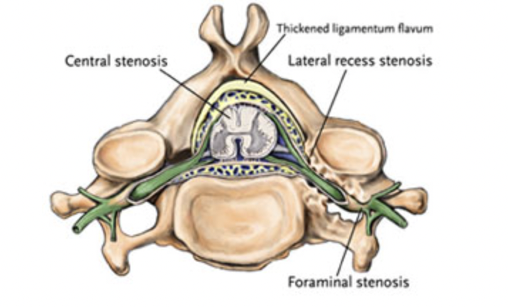 * carpal tunnel (occurs when nerves are compressed in wrist)
* ulnar nerve entrapment
  * occurs when the ulnar nerve in the arm becomes compressed or irritated
* foraminal (lateral) stenosis 
  * Each of the 33 bones of the spine has a large central opening for the spinal cord. Additional openings called foramen, which can get clogged, allow the nerves branching from the spinal cord to travel to the arms, legs and other parts of the body.