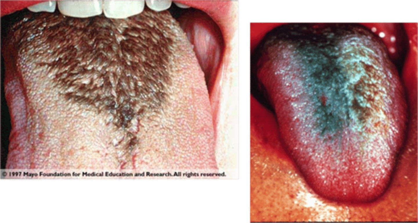<p>Black Hairy Tongue</p>