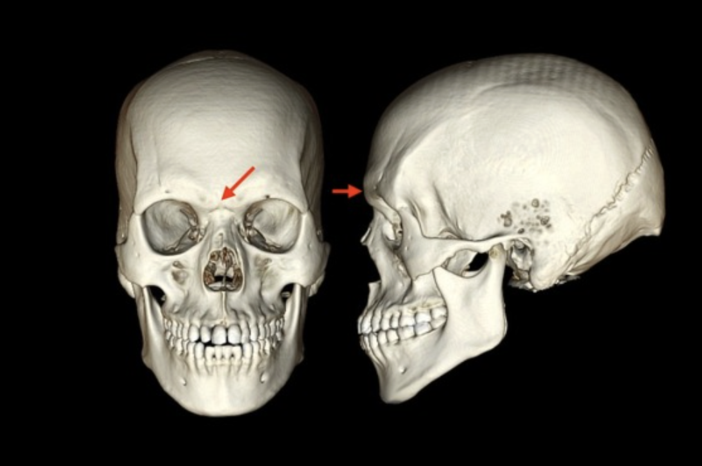 <p>frontal bone</p>