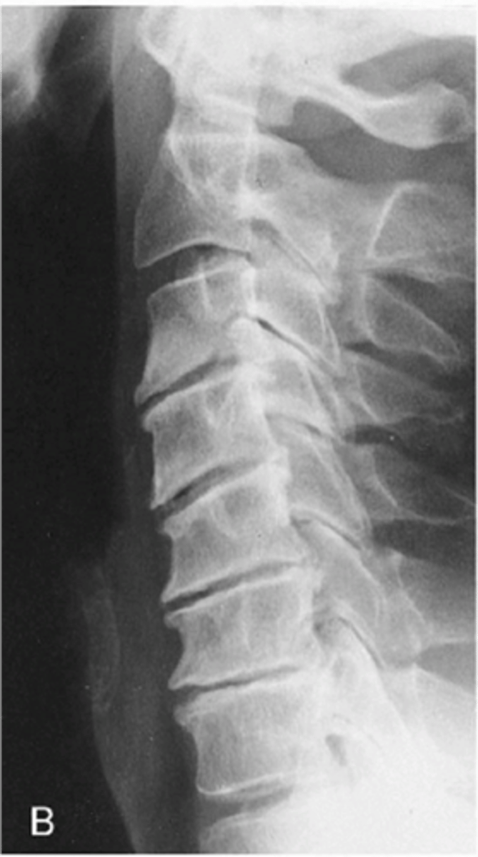 <p>State the radiographic features of degeneration of the intervertebral disc</p>