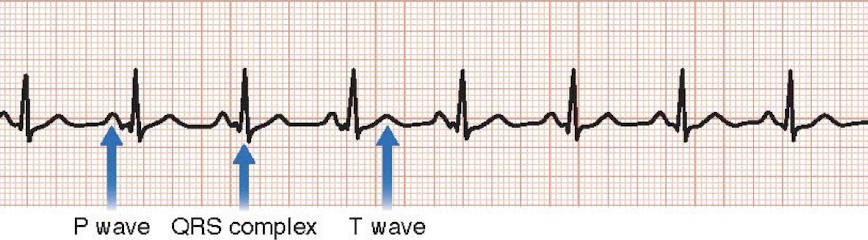 <p>Normal waves </p>