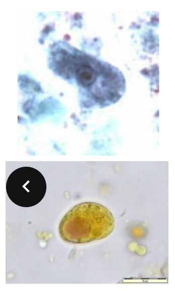 <p>Pathogenicity - None</p><p>Morphology - Iodine cyst (large glycogen vacuole which stains dark brown with iodine)</p>