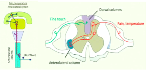 -the pathway for pain and temperature information to get to the brain 
-the pathway allows for pain to be precisely located 
1. a-delta and c fibers coming from the skin's surface enter the spinal cord at the dorsal horn
2. axons move into the gray matter of the dorsal region of the spinal cord and make excitatory synapses with second order neurons here
3. axons of second order neurons cross the midline of the spinal cord and enter the ventral region of the spinal cord gray matter on the contralateral side 
4. axons of second order neurons enter the anterolateral column to travel up to the thalamus (VPL)
5 second order neurons synpase with thalamic neurons 
6 the axons of thalamic neurons travel to the primary somatic sensory cortex in the internal capsule
-NOTE: other branches of thalamic neurons are what control the emotion and feelings associated with pain in other areas of the cortex 
-will lose pain and temperature sensation on the side of the body opposite to the lesion in the spinal cord