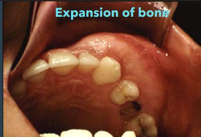 <p>expansion of both the buccal and lingual plates </p>