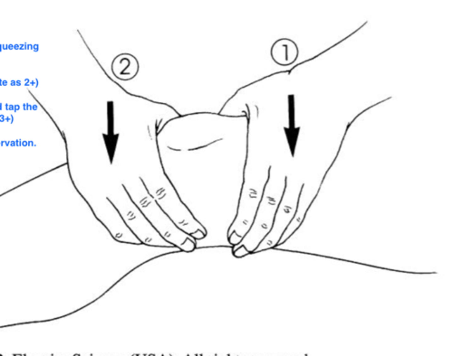 <p>Knee joint effusion</p>