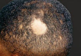 <p>alopecia with an onset usually prior to 30 years</p><p>-men and women are equally affected</p><p>-causes bald spots</p>