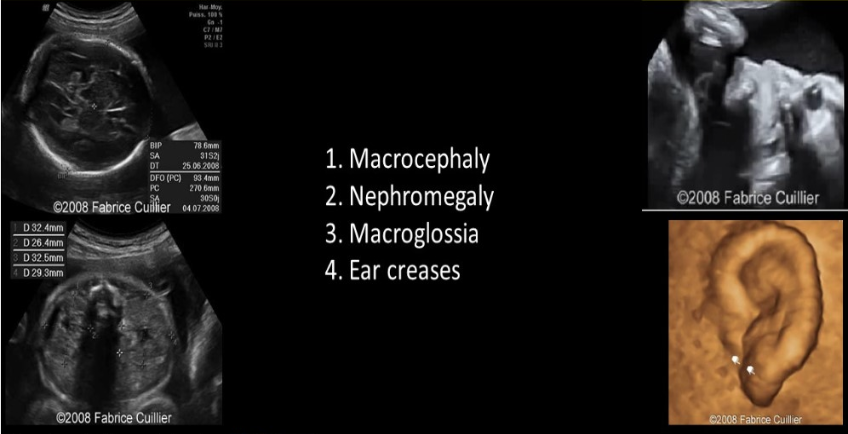 <p>which is strongly assoc w/ fetal dysphagia + polyhydramnios</p><p>.</p><p>a) potter syndrome</p><p>b) meckel gruber syndrome</p><p>c) ebstein anomaly</p><p>d) beckwith wiedemann syndrome</p>