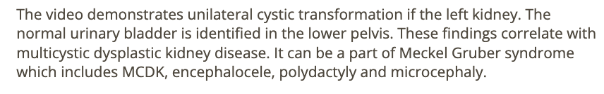 <p>b) meckel gruber syndrome</p>