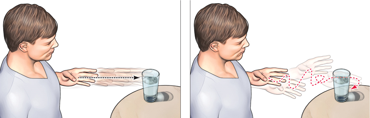<ul><li><p>irregular movements that typically overshoot or undershoot the visual target</p></li><li><p>require frequency corrective movements</p></li></ul><p></p>