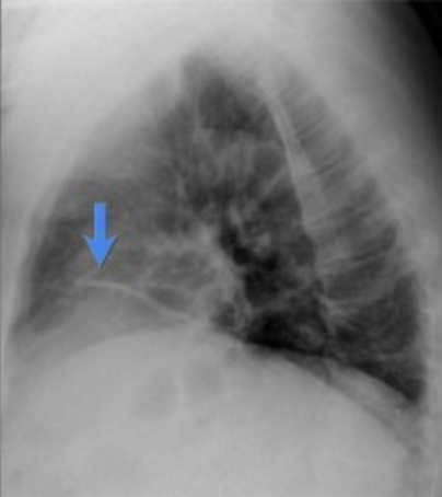 <p>Atelectasis: CXR</p>