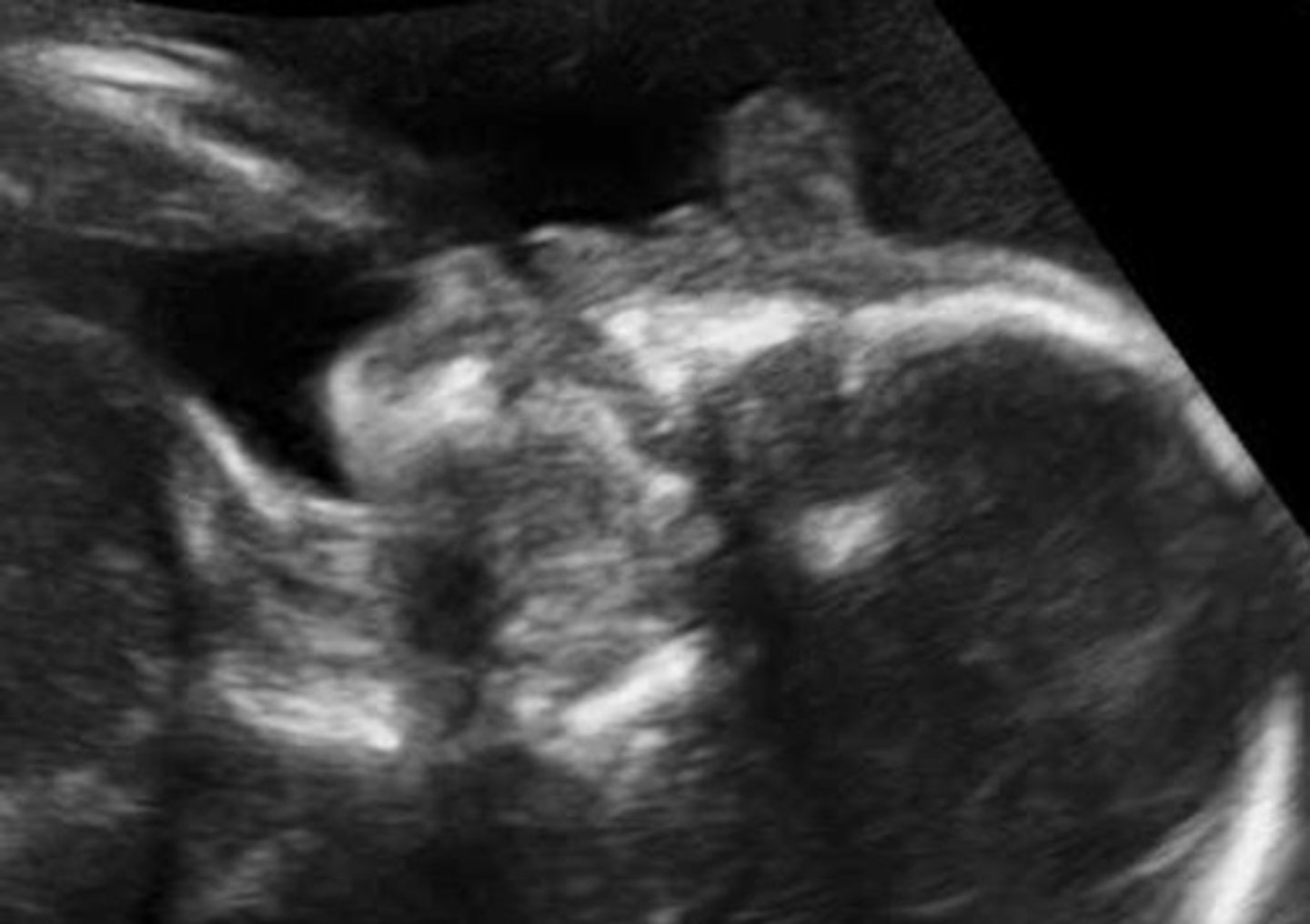 <p>Flap of tissue superior to eyes - nose is usually absent</p>