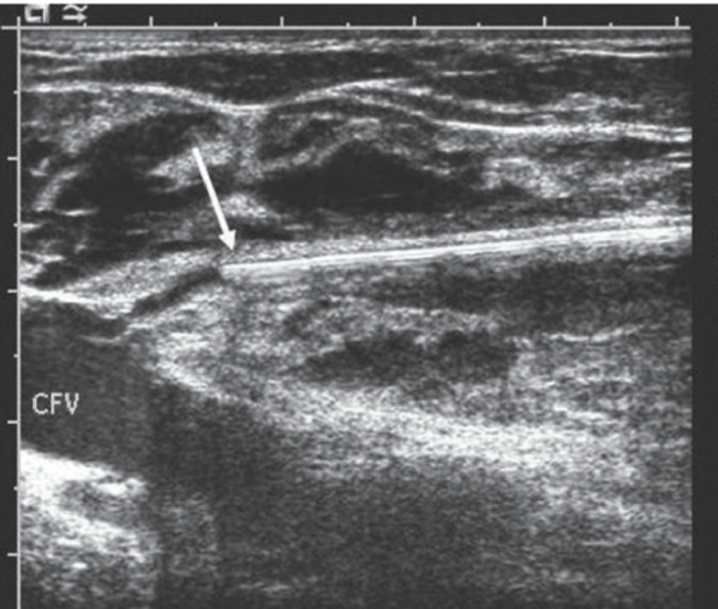 <p>Vein closed from within itself via laser/catheter</p>
