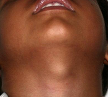 <p>palpable midline neck mass in kids (most common congenital neck cyst)</p>