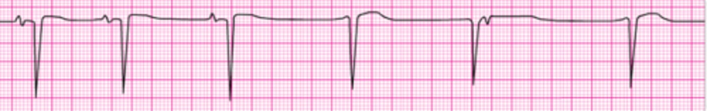 <p>A patient becomes unresponsive. You are uncertain if a faint pulse is present with the rhythm</p><p>below. What is your next action?</p><p>1. Order transcutaneous pacing.</p><p>2. Begin CPR, starting with high-quality chest compressions.</p><p>3. Start an IV and give epinephrine 1 mg IV.</p><p>4. Consider causes of pulseless electrical activity.</p><p>5. Start an IV and give atropine 1 mg.</p>