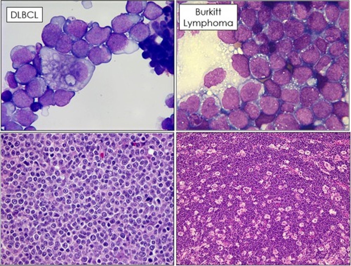 <p>Most common aggressive lymphoma in adults.</p>
