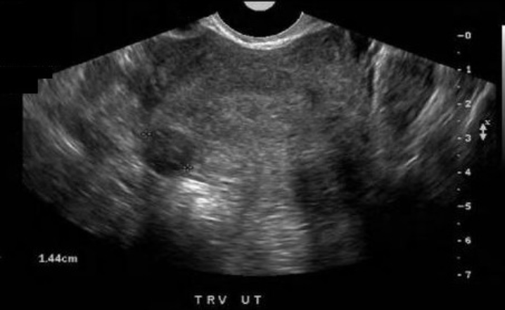 <p>what type of fibroid is this</p><p>a) pedunculated</p><p>b) subserosal</p><p>c) submucosal</p><p>d) intramural</p>