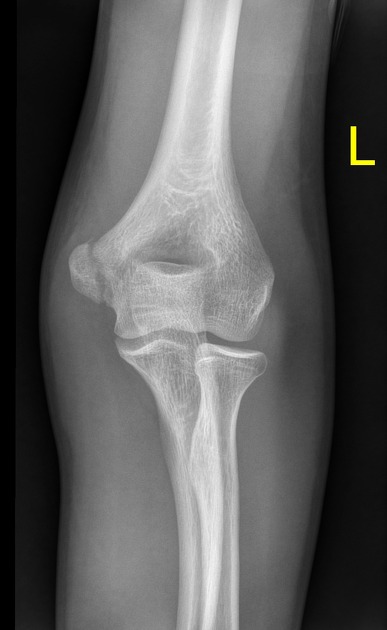 <p>Describe the abnormality demonstrated.</p>