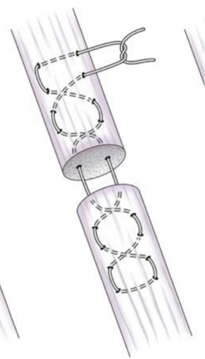 <p>what ligament/tendon suture pattern is shown here that is has fallen out of favor as it cuts off blood supply</p>