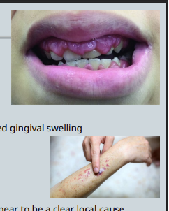 <ul><li><p>29 year old female <strong>Medically well</strong>, takes <strong><u>no</u></strong> regular medications Complaining of bleeding and gums </p></li><li><p>Dental clinic receptionist </p></li><li><p>Seen by one of the dentists, who notes <strong>significant generalised gingival swelling</strong> </p></li><li><p>Reasonably good plaque control </p></li><li><p>Pocket depths 3-4mm in all quadrants </p></li><li><p>Radiographs – <strong>no bone loss</strong></p></li><li><p><strong> ask questions - </strong><em>have you noticed anything? weight loss without trying? difficulty swallowing? fever?</em></p></li><li><p><strong>New rash on her arms </strong></p></li><li><p>Clinician suspected something <strong>systemic</strong>, as there did <strong>not </strong>appear to be a clear local cause </p></li></ul><p></p>
