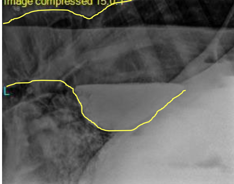 <p>presumptive diagnosis via clinical signs</p><p>definitive diagnosis via endoscopy, esophogram (barium swallow)</p>