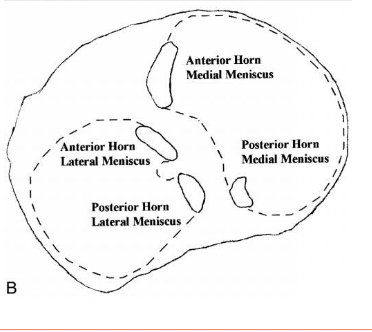 <ul><li><p>Structure: semilunar wedges</p><ul><li><p>Fibrocartilage</p></li><li><p>Circumferential fibers (outside run longitudinally)</p></li><li><p>Radial fibers (inside to outside)</p></li><li><p>Blood vessels penetrate the outer third</p></li></ul></li><li><p>Functions:</p><ul><li><p>Load bearing → absord and distribute loads (contact forces) over the articular surface</p></li><li><p>stability to joint by increasing fit and resisting AP displacements</p></li><li><p>Proprioception (sense position awareness and motion)</p></li></ul></li><li><p>Anatomy:</p><ul><li><p>Medial: C-shaped</p></li><li><p>Lateral discoid (more mobile)</p></li><li><p>Stability:</p><ul><li><p>Anterior: transverse ligaments</p></li><li><p>Coronary (menisco-tibial ligaments</p><ul><li><p>MCL and capsular attachments</p></li><li><p>Horn attachments: root ofr spine</p></li></ul></li><li><p>Posterior-menisco femoral ligaments</p></li></ul></li></ul></li></ul><p></p>