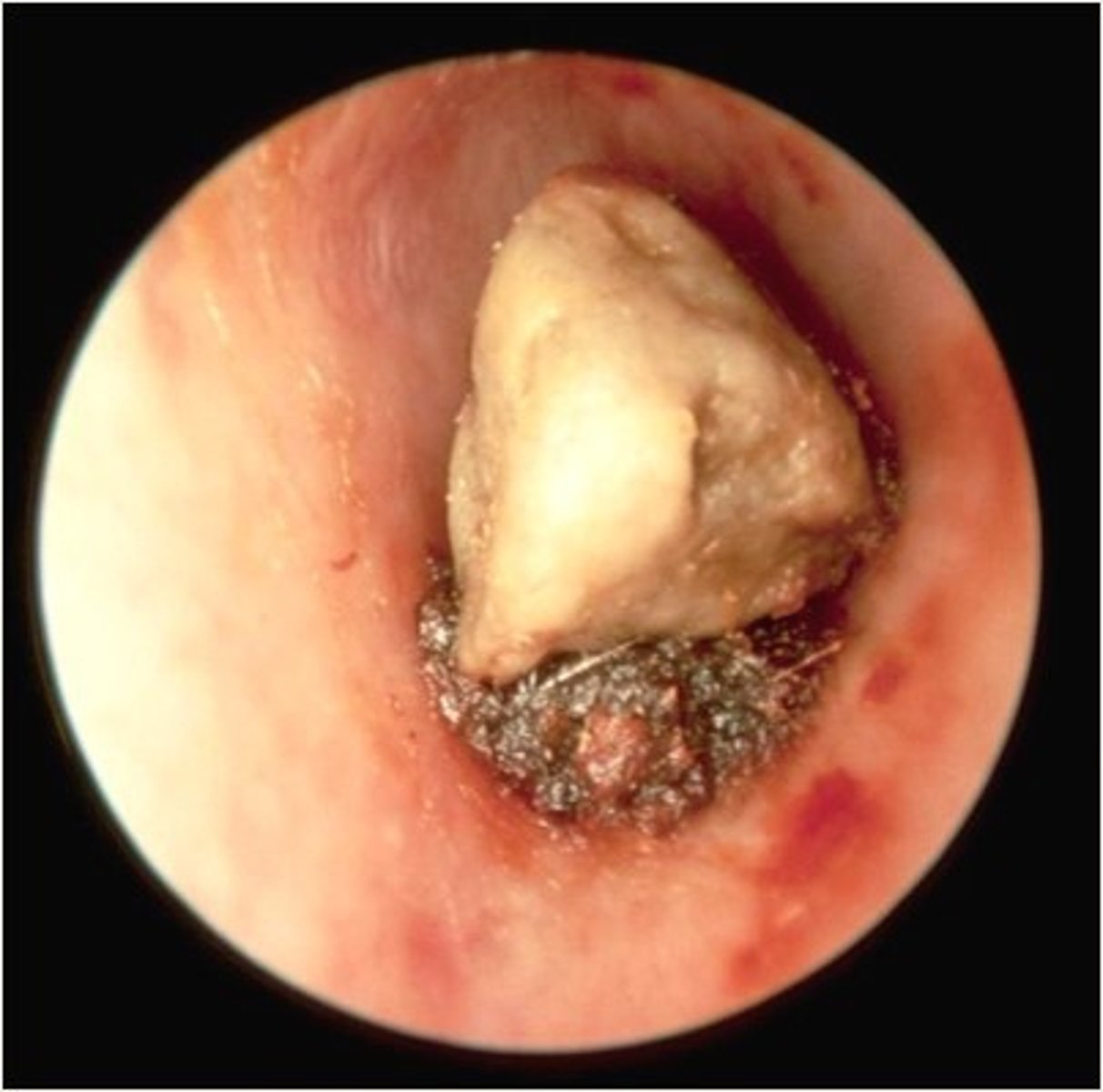 <p>Varied</p><p>Causes conductive HL</p><p>May result in:</p><p>Secondary OE</p><p>TM or occicle damage</p>