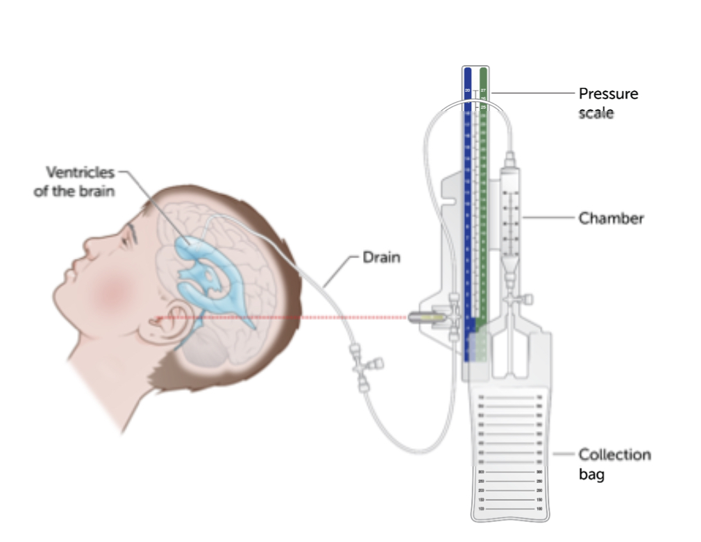 <p><strong>excess fluid in the ventricle in the brain</strong></p><p></p><p>3 types</p><ol><li><p>congenital</p></li><li><p>acquired (post injury or surgery)</p></li><li><p>infectious (usually time limited)</p></li></ol><p></p><p>management: <strong>meds, external ventricular drain, shunts</strong></p><p></p><p>nursing considerations: infection, monitor for signs of increased ICP, malfunction, education/when to call</p><p></p>