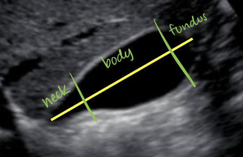 <ul><li><p>parts: <mark data-color="yellow" style="background-color: yellow; color: inherit;">neck</mark> (superior portion), <mark data-color="yellow" style="background-color: yellow; color: inherit;">body</mark>, and <mark data-color="yellow" style="background-color: yellow; color: inherit;">fundus</mark> (inferior portion; close to bowel)</p></li><li><p>around <u>9 cm</u> from neck to fundus</p></li><li><p>GB <u>>12 cm</u> is considered <u>hydrops</u></p></li><li><p>holds up to 40 mL of bile</p></li><li><p>supplied by cystic artery</p></li></ul><p></p>