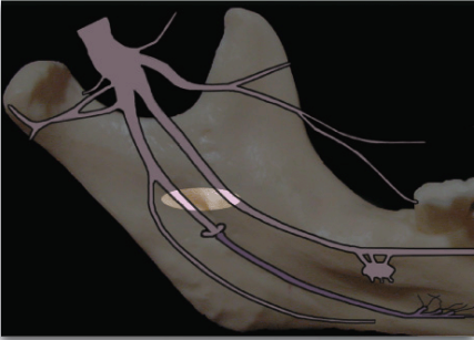 <ul><li><p>Same for inferior alveolar nerve block </p></li><li><p>Withdraw needle halfway after inferior alveolar nerve block and deposit local anesthetic solution</p></li></ul><p></p>