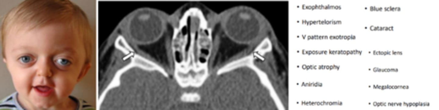 <p>the most common cranio-facial syndrome occurring due to mutation of the fibroblast growth factor gene (FGFR2) or by spontaneous mutation 50% of the time. Begins in the first year and completes by the 2nd to 3rd year. Involves brachycephaly, underdevelopment of the maxillary and zygomatic bones, wide cranium, hearing loss, and V shaped palate. Characteristic "frog like face".</p>