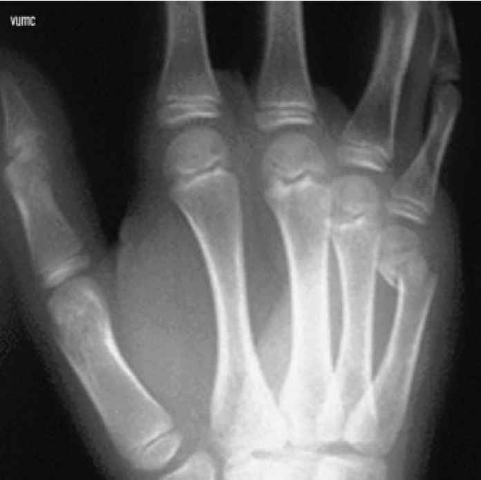 <p>What fracture does this hand have? Is the patient young or old and how do you know? </p>