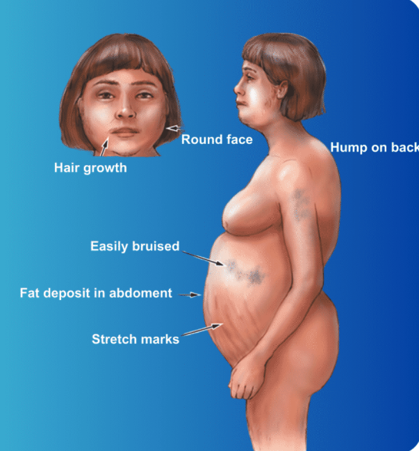 <p>Cushing's syndrome is a disorder caused by prolonged exposure to high levels of cortisol. It can result from endogenous factors (overproduction by the body) or exogenous factors (prolonged use of corticosteroid medications). The condition affects multiple organ systems, leading to significant physical and metabolic changes.</p><p>The most common cause is by a tumor in the <strong>pituitary gland</strong> that secretes excess ACTH (adrenocorticotropic hormone), overstimulating the adrenal glands.</p><p>Cushing’s syndrome presents with a range of distinctive physical features and systemic effects due to prolonged exposure to high cortisol levels. Notable physical changes include a rounded, full face, often called "<strong>moon face</strong>," and a "<strong>buffalo hump</strong>," caused by fat accumulation on the back of the neck and upper back. Fat tends to concentrate in the abdomen, leading to <strong>central obesity with relatively thin limbs</strong>. <strong>Wide, purple or reddish stretch marks (striae)</strong> are commonly seen on the abdomen, thighs, or breasts. Additionally, the skin becomes <strong>thinner and more fragile</strong>, making it <strong>prone to bruising</strong> and slow wound healing. Women may experience excessive <strong>facial or body hair growth </strong>(hirsutism) due to hormonal imbalances.</p><p>Metabolic, cardiovascular, and immune system effects further compound the condition's severity. <strong>Hyperglycemia</strong> frequently occurs as cortisol promotes gluconeogenesis, and protein catabolism leads to <strong>muscle wasting</strong> and weakness. <strong>Bone loss</strong>, or osteoporosis, is a common complication, increasing the risk of fractures. Elevated cortisol also enhances vascular sensitivity to catecholamines, resulting in <strong>hypertension</strong>. <strong>Immune suppression</strong> leaves individuals more susceptible to infections, while the psychological impact includes <strong>mood swings, depression, anxiety, and cognitive impairments</strong>, all contributing to the disorder's complex presentation.</p>