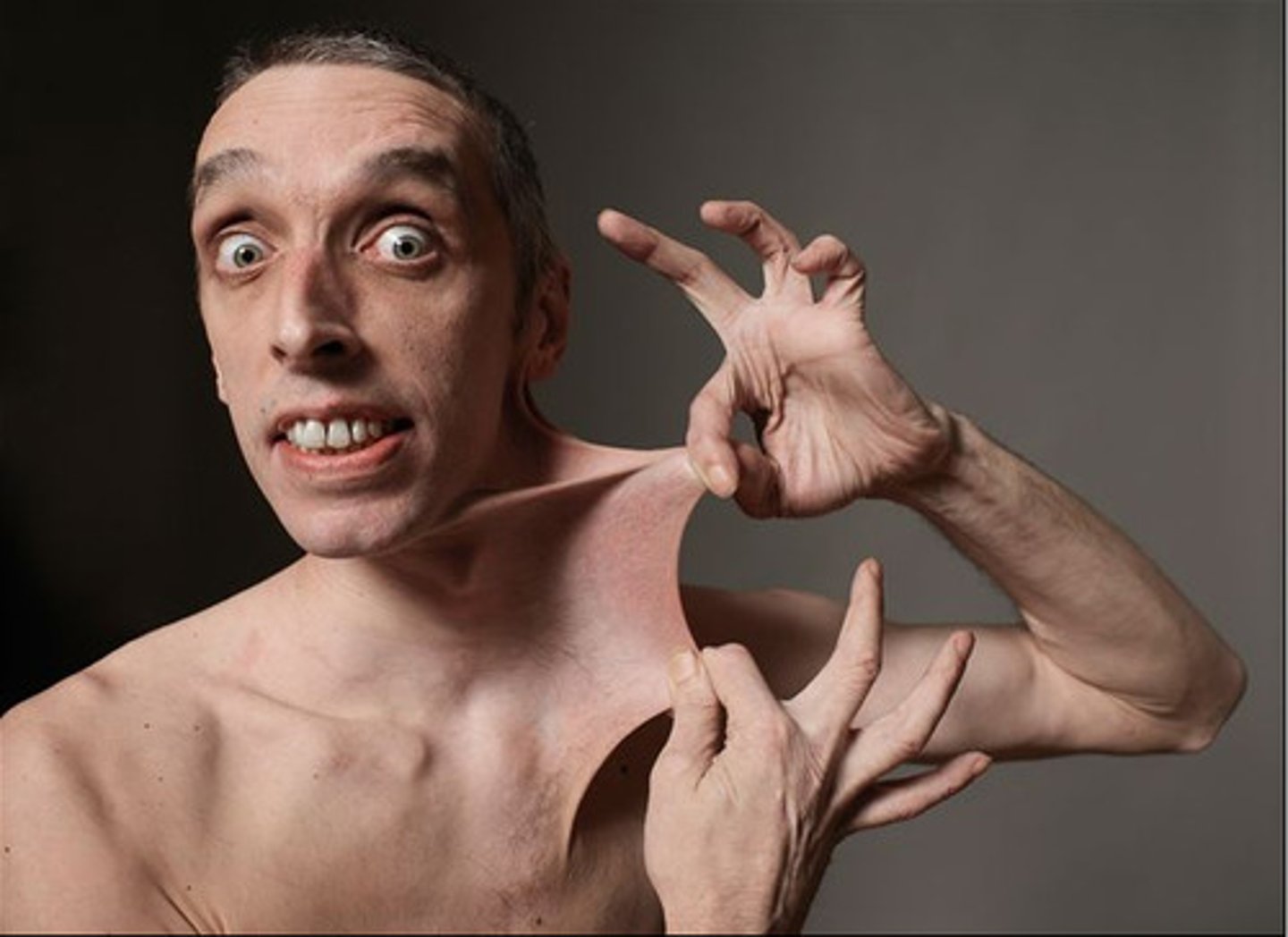 <p>Ehlers-Danlos syndrome</p><p>(type V collagen defect, type III collagen defect seen in vascular ED)</p><p>Pro collagen molecules are not cleaved (N/C removal impaired)</p>