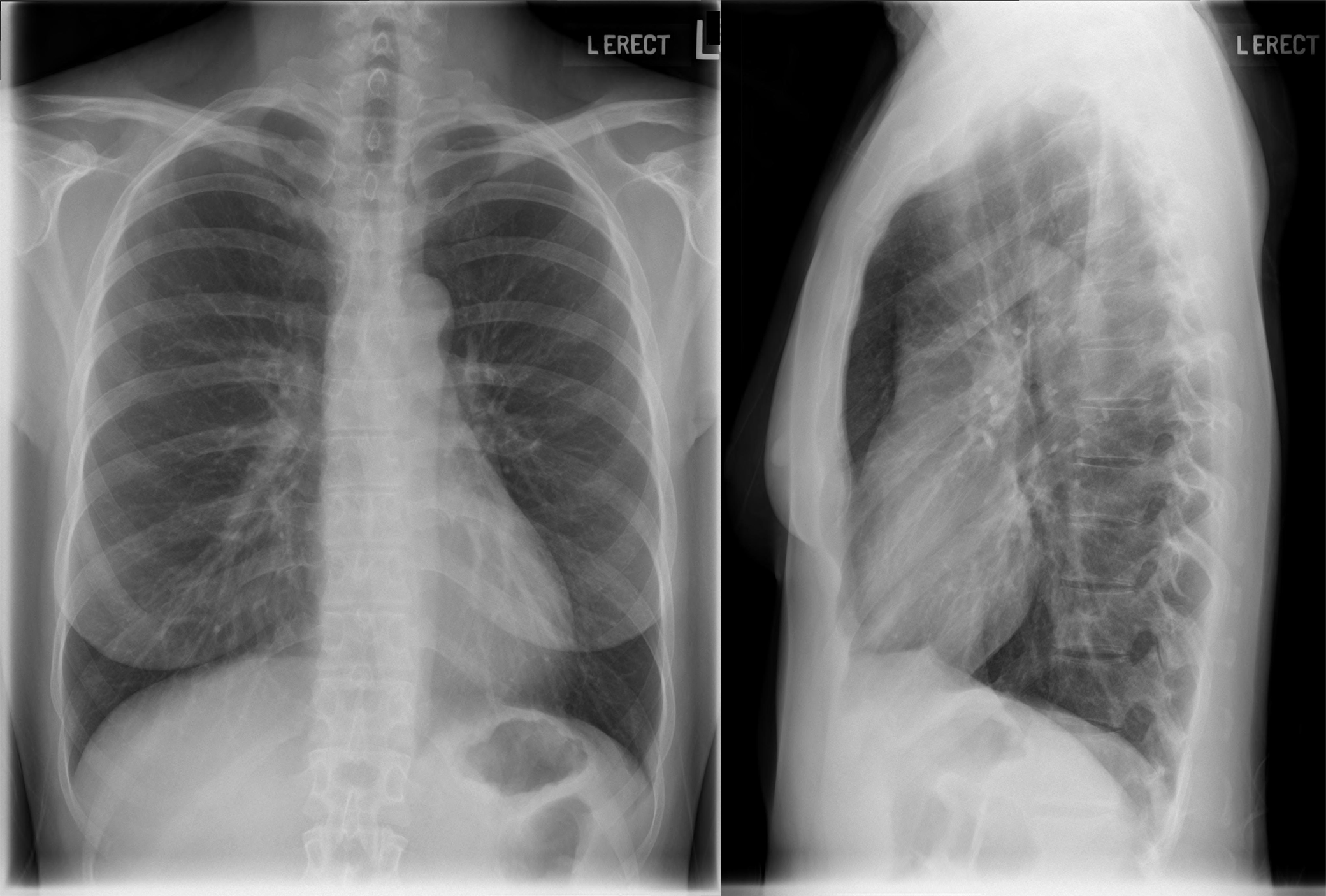<p>Heart borders, diaphragm edges, and lung markings.</p>