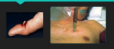 <p>what kind of wound is this</p>
