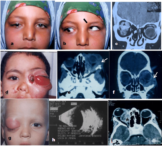 <ul><li><p>an aggressive sarcoma</p></li><li><p>can occur in many areas including:</p><ul><li><p>the eye</p></li><li><p>muscles around the eye</p></li></ul></li></ul><p></p>