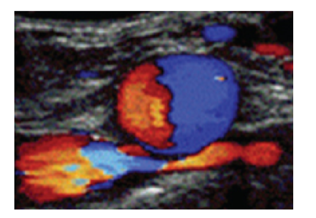 <p>Compression of Left Common Iliac Vein by Right Common Iliac Artery against the lumbar vertebrae with or without DVT</p><p>– Causes stasis of the LCIV, often results in DVT</p><p>Typically diagnosed in women in 20s to 40s after prolonged immobilization or pregnancy</p><p></p><p>youll see High velocities venous flow or Doppler silence in LCIV Continuous waveforms distally in Left LLE vein (including EIV and CFV)</p>