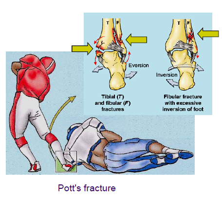 forced eversion/ abduction of the foot; medial ligament detaches medial malleolus or the medial ligament tears, and the fibula fractures at a higher level. 