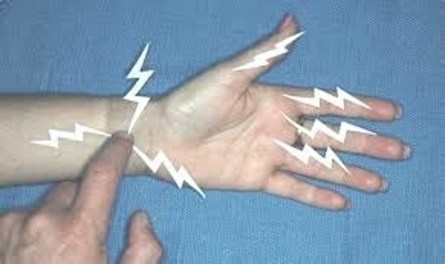 <p>Used for Dx of Carpal Tunnel Syndrome</p><p>Physician taps over the volar aspect of the pts transverse carpal ligament</p><p>Positive test will cause tingling or paresthesia into the thumb, index, middle or lateral half o the ring finger</p>