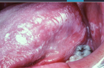 <p>topical allergic reaction </p>